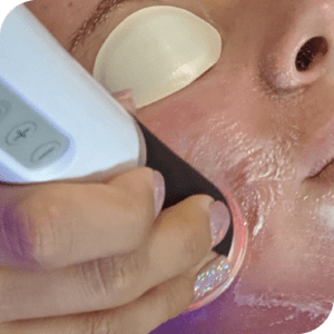 Exfoliation
Exfoliation & Targeting Pigmentation